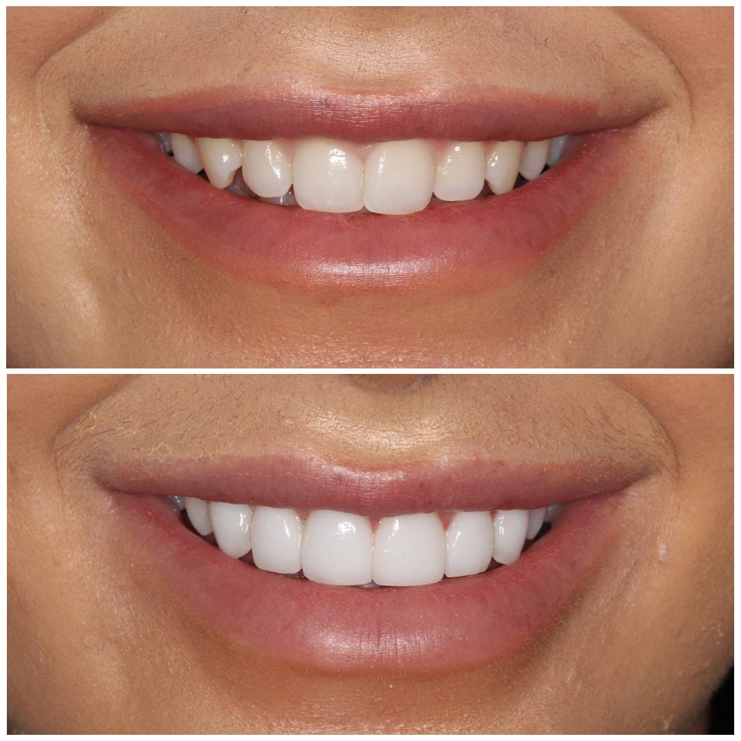 smiling-dental-porcelain-veneers-before-after