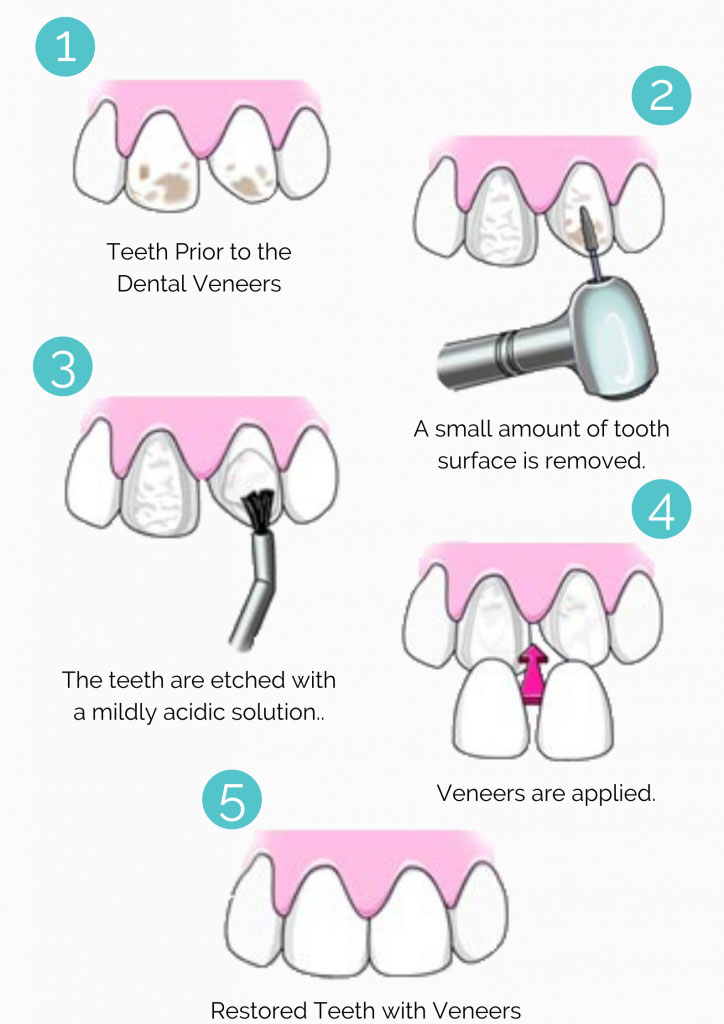 veneer-procedure